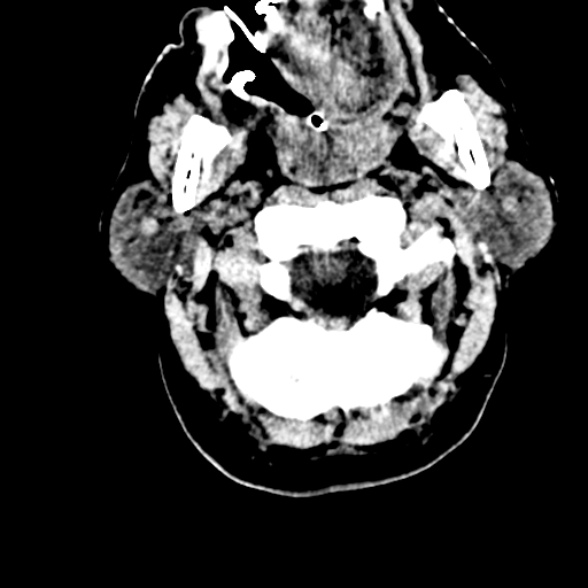 Basilar artery thrombosis (Radiopaedia 53351-59352 Axial non-contrast 12).jpg