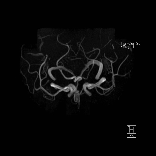 Basilar tip aneurysm (Radiopaedia 26504-26632 D 22).jpg