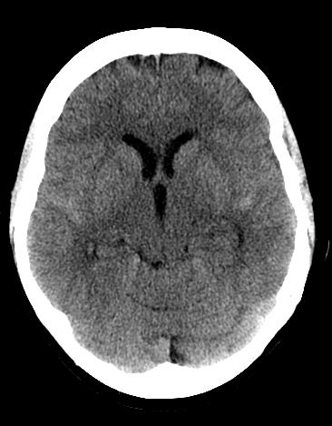 File:Basilar tip aneurysm with coiling (Radiopaedia 53912-60033 Axial non-contrast 12).jpg