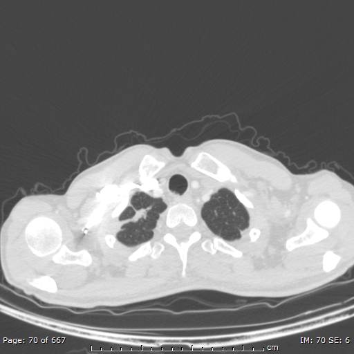 Behçet disease (Radiopaedia 44247-47889 Axial lung window 3).jpg