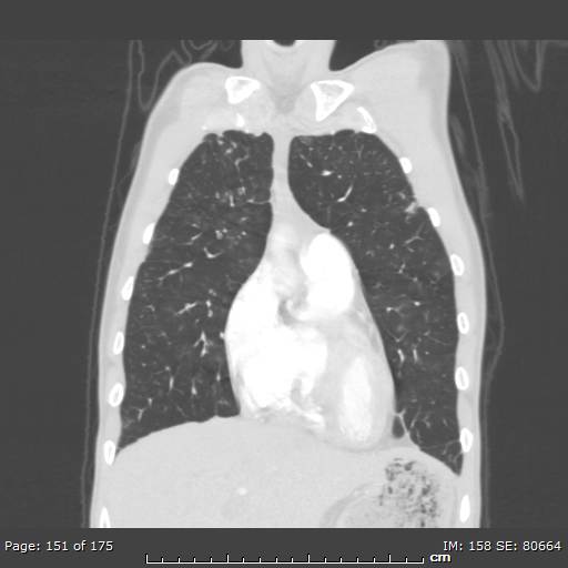 Behçet disease (Radiopaedia 44247-47889 Coronal lung window 48).jpg