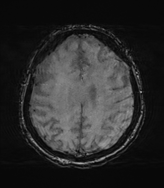 File:Behavioral variant frontotemporal dementia and late onset schizophrenia (Radiopaedia 52197-58083 Axial SWI 53).png