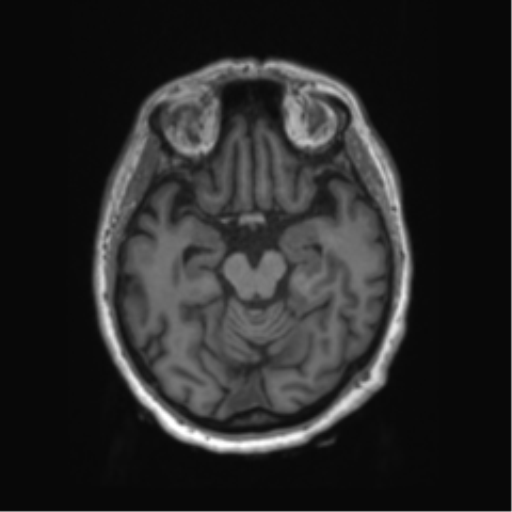 File:Behavioral variant frontotemporal dementia and late onset schizophrenia (Radiopaedia 52197-58083 Axial T1 67).png
