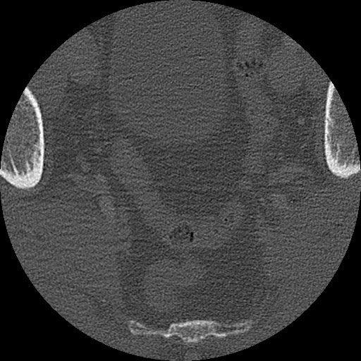 Benign post-traumatic pseudopneumoperitoneum (Radiopaedia 71199-81495 Axial bone window 312).jpg