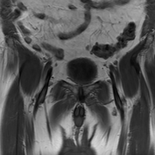 File:Benign prostatic nodular hyperplasia (Radiopaedia 16917-16634 Coronal T1 4).jpg