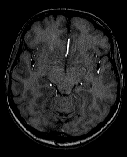 Berry aneurysm of the terminal internal carotid artery (Radiopaedia 88286-104918 Axial TOF 112).jpg