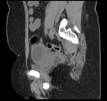 File:Bicornuate uterus (MRI) (Radiopaedia 49206-54296 Sagittal 8).png