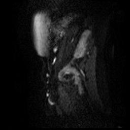 File:Bicornuate uterus (Radiopaedia 51676-57472 Sagittal DWI 3).jpg