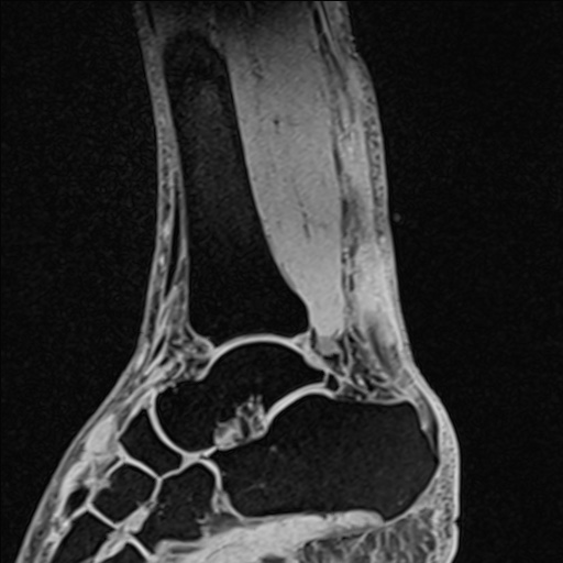 Bilateral Achilles tendon complete tear (Radiopaedia 81344-95051 Sagittal WE - Left 64).jpg