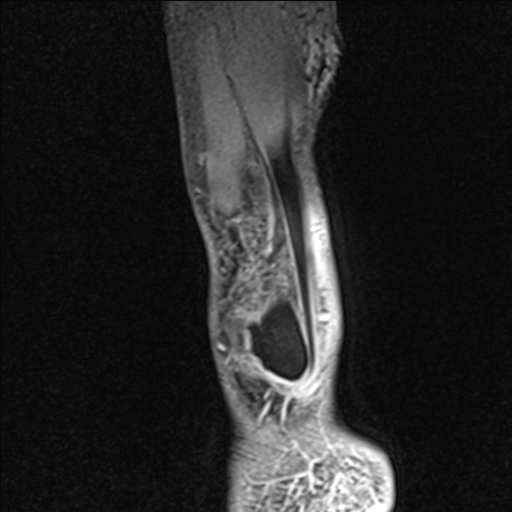 Bilateral Achilles tendon complete tear (Radiopaedia 81344-95051 Sagittal WE - Right 15).jpg