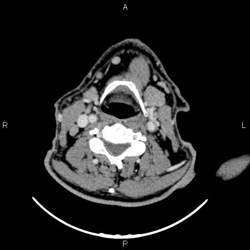 Bilateral Warthin tumors (Radiopaedia 84034-99263 Axial With contrast 39).jpg