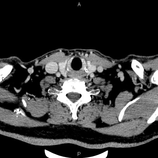 Bilateral Warthin tumors (Radiopaedia 84034-99263 Axial With contrast 53).jpg