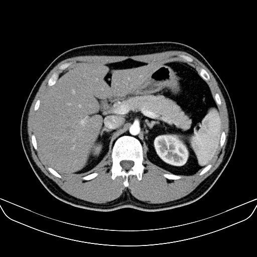 Bilateral accessory renal arteries with mild pelvi-ureteric junction (PUJ) obstruction (Radiopaedia 66357-75596 A 14).jpg