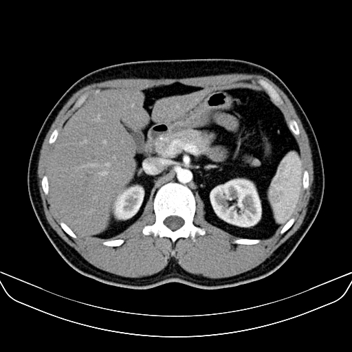 Bilateral accessory renal arteries with mild pelvi-ureteric junction (PUJ) obstruction (Radiopaedia 66357-75596 A 16).jpg