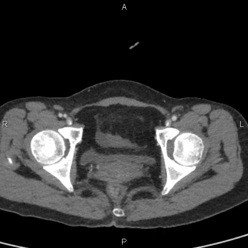 Bilateral adrenal gland hyperenhancement in pancreatitis (Radiopaedia 86642-102753 E 105).jpg