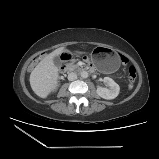 Bilateral adrenal granulocytic sarcomas (chloromas) (Radiopaedia 78375-91007 A 56).jpg