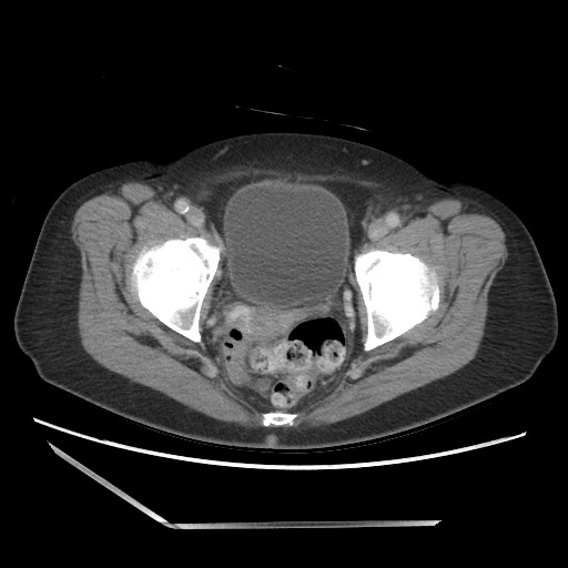 File:Bilateral adrenal granulocytic sarcomas (chloromas) (Radiopaedia 78375-91007 Axial 80).jpg