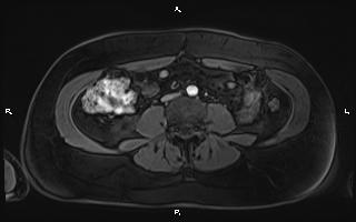Bilateral adrenal myelolipoma (Radiopaedia 63058-71537 Axial T1 C+ fat sat 69).jpg