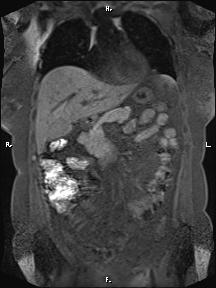 File:Bilateral adrenal myelolipoma (Radiopaedia 63058-71537 Coronal T1 fat sat 69).jpg