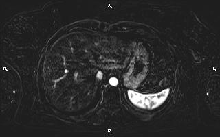 Bilateral adrenal myelolipoma (Radiopaedia 63058-71537 I 19).jpg