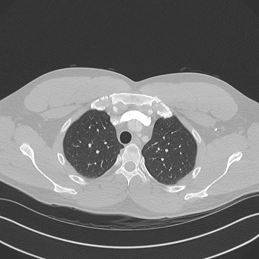 Bilateral atelectasis (Radiopaedia 48666-53675 Axial lung window 22).jpg