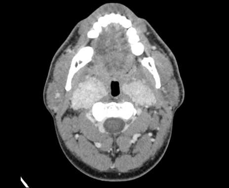 Bilateral carotid body tumors (Radiopaedia 61841-69870 Axial Post contrast 30).jpg