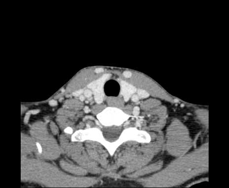 Bilateral carotid body tumors (Radiopaedia 61841-69870 Axial Post contrast 92).jpg