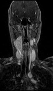 File:Bilateral carotid body tumors and right glomus jugulare tumor (Radiopaedia 20024-20060 MRA 22).jpg