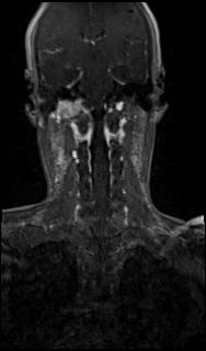 File:Bilateral carotid body tumors and right glomus jugulare tumor (Radiopaedia 20024-20060 MRA 47).jpg