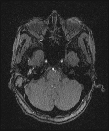 File:Bilateral carotid body tumors and right jugular paraganglioma (Radiopaedia 20024-20060 Axial 155).jpg