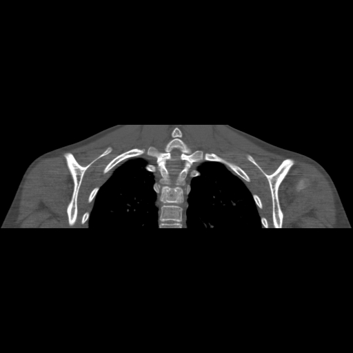 Bilateral chronic posterior shoulder dislocation (Radiopaedia 39213-41452 Coronal bone window 43).jpg