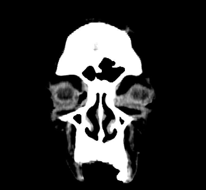 Bilateral ectopia lentis (Radiopaedia 89889-107013 Coronal non-contrast 12).jpg