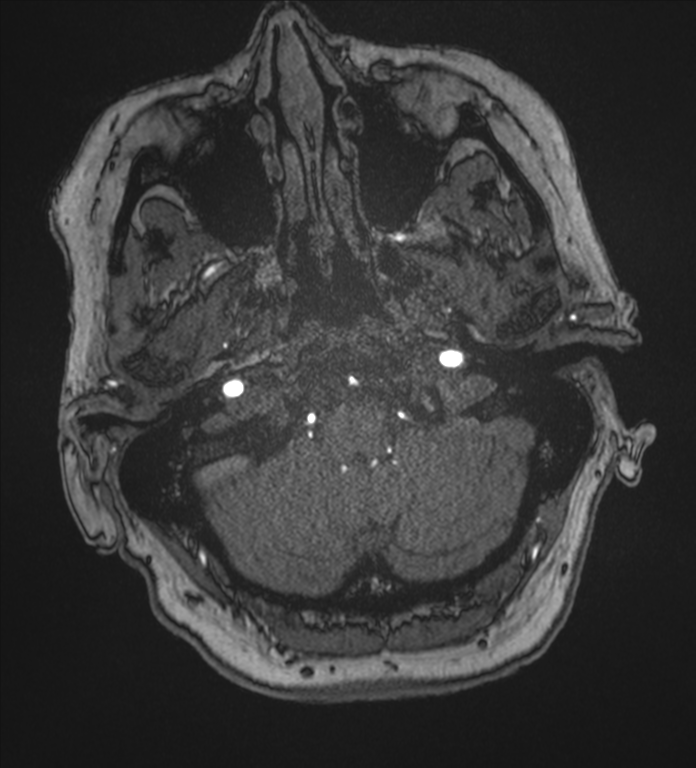 Bilateral fetal posterior communicating arteries (Radiopaedia 41286-44102 Axial MRA 13).png