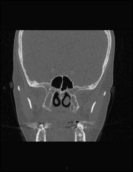 Bilateral frontal mucoceles (Radiopaedia 82352-96454 Coronal 216).jpg