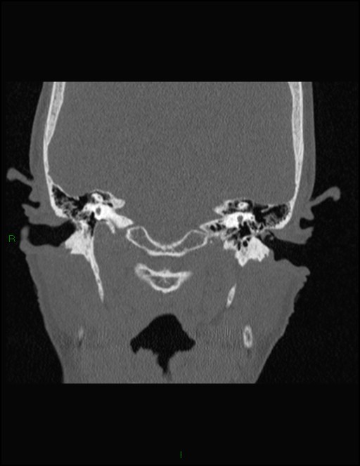 Bilateral frontal mucoceles (Radiopaedia 82352-96454 Coronal 311).jpg
