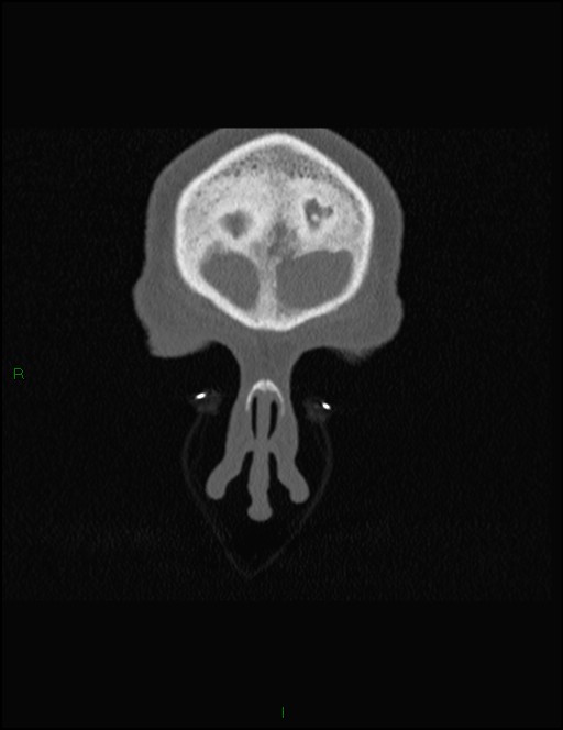 Bilateral frontal mucoceles (Radiopaedia 82352-96454 Coronal 38).jpg