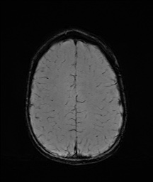 Bilateral mesial temporal polymicrogyria (Radiopaedia 76456-88181 Axial SWI 54).jpg