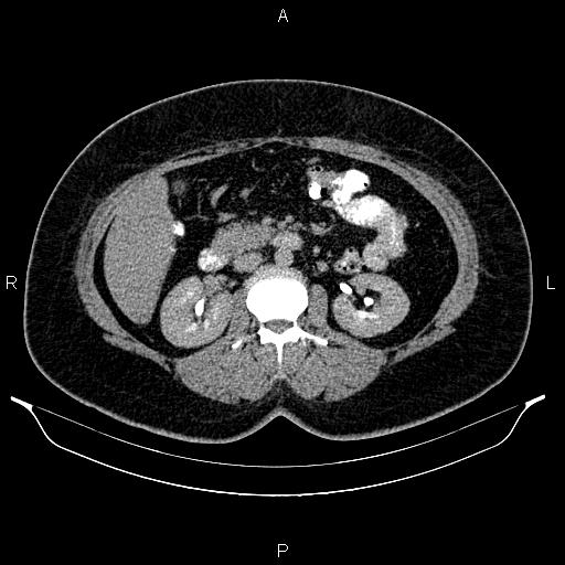 Bilateral ovarian dermoid cysts (Radiopaedia 85785-101603 Axial C+ delayed 29).jpg