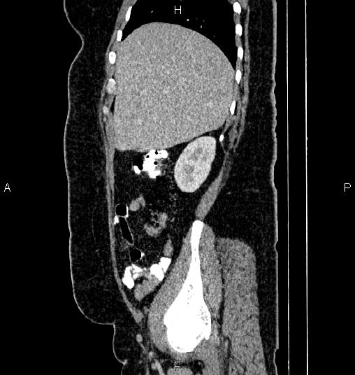 Bilateral ovarian dermoid cysts (Radiopaedia 85785-101603 D 17).jpg