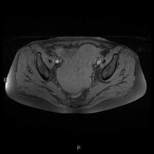 File:Bilateral ovarian fibroma (Radiopaedia 44568-48293 Axial T1 fat sat 14).jpg