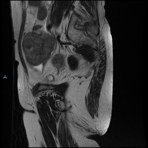 File:Bilateral ovarian fibroma (Radiopaedia 44568-48293 Sagittal T2 9).jpg