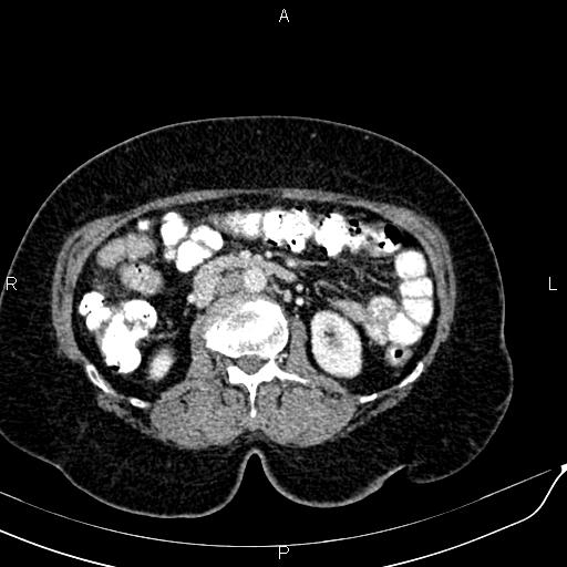 Bilateral ovarian serous cystadenocarcinoma (Radiopaedia 86062-101989 B 47).jpg
