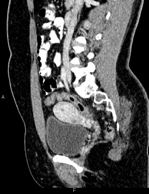 Bilateral ovarian teratoma (Radiopaedia 83131-97503 D 55).jpg