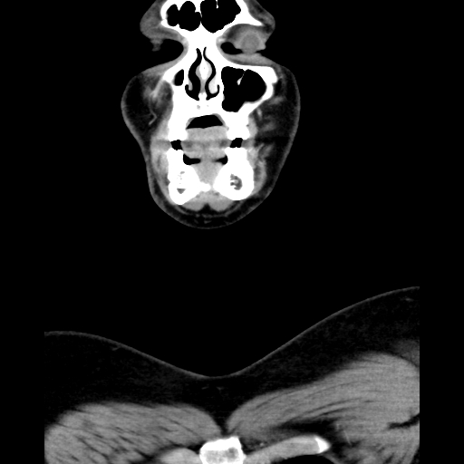 Bilateral peritonsillar abscess (Radiopaedia 85065-100610 Coronal 14).jpg