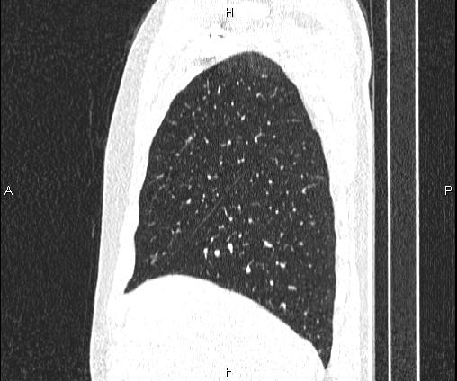 File:Bilateral pulmonary AVM (Radiopaedia 83134-97505 Sagittal lung window 32).jpg