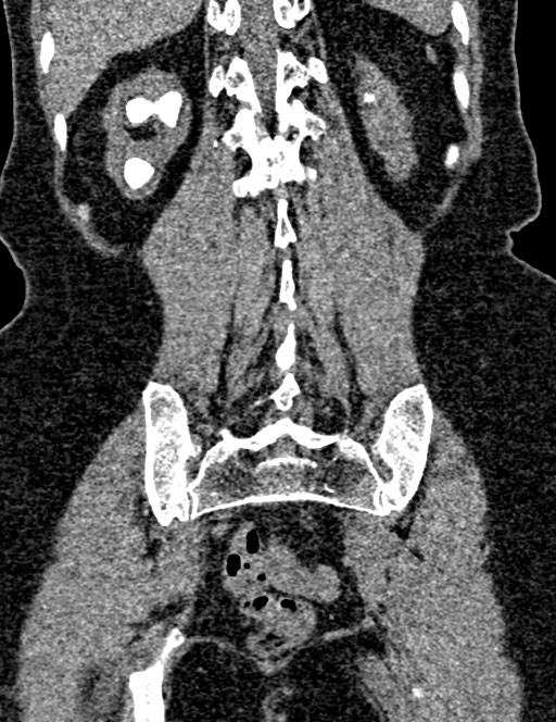 Bilateral staghorn calculi (Radiopaedia 59475-66842 Coronal non-contrast 80).jpg