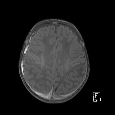 File:Bilateral subdural hemorrhage and parietal skull fracture (Radiopaedia 26058-26190 Axial T1 37).png