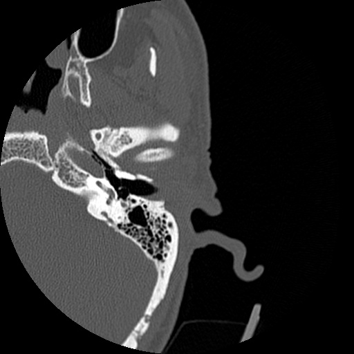File:Bilateral temporal bone fractures (Radiopaedia 29482-29970 Axial 71).jpg