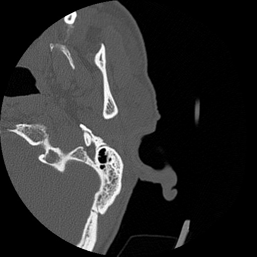 Bilateral temporal bone fractures (Radiopaedia 29482-29970 D 7).jpg