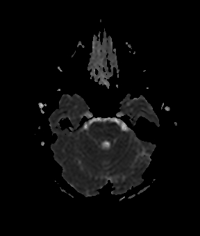 File:Bilateral thalamic gliomata (Radiopaedia 42538-45664 Axial ADC 7).jpg